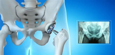 Hip Arthroplasty - Best Joint Replacement Surgeon