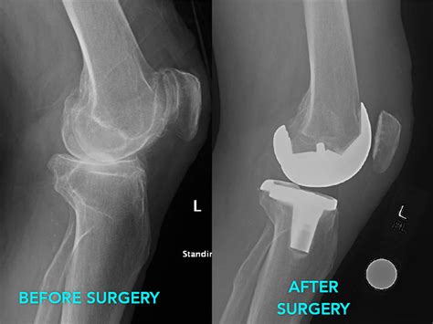 Arthroplasty - Joint Replacement Surgery, Hip, Knee, Shoulder, Thumb