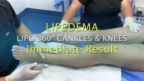 Lipedema | Lipo 360° Legs | Leg Liposuction Surgery Results | Cankles & Knees | Expert Dr ...