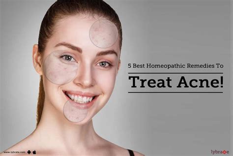 5 Best Homeopathic Remedies To Treat Acne! - By Dr. Deepanjli | Lybrate