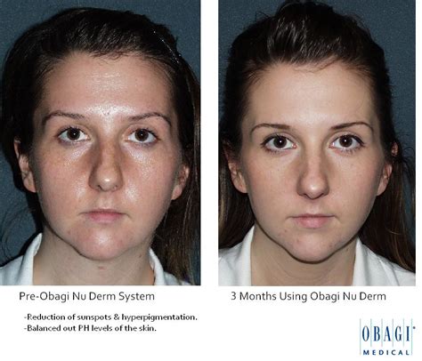 BEFORE & AFTER OBAGI | Obagi Nu Derm System before and after… | Yeung ...