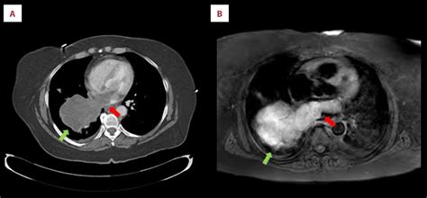 Chest Mri Anatomy