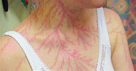 Lichtenberg Scars — Nature’s Tattoo You Don’t Want To Have | Lightning photography, Lightning ...