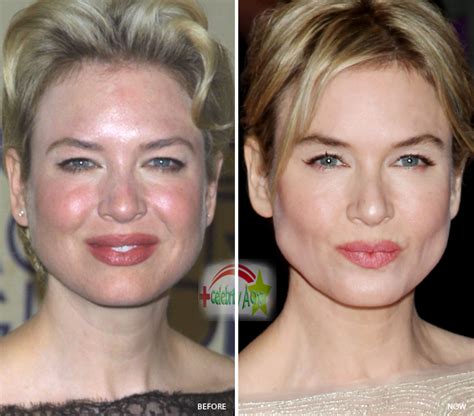 Do celebrities get acne? - Celebrity acne scars - Celebrities with Acne ...