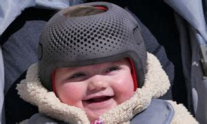 Why Do Down Syndrome Babies Wear Helmets? - Flat Head Syndrome