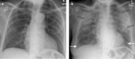 Bronchopneumonia Chest X Ray