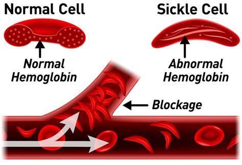 Acute Chest Syndrome: A Complication of the Sickle Cell Disease