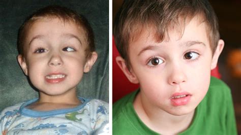 Strabismus repair, before and after | My son had surgery to … | Flickr