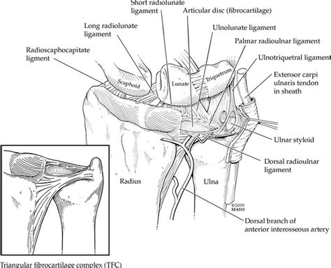 What Is A TFCC Tear Of The Wrist? | Sydney Physio Clinic