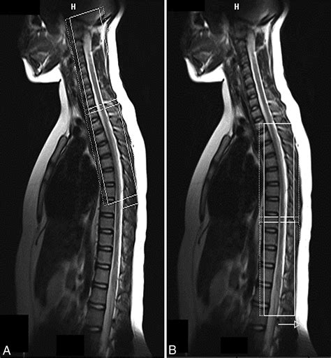 Normal Thoracic Spine Mri