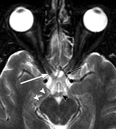 Appearance of Normal Cranial Nerves on Steady-State Free Precession MR Images | RadioGraphics