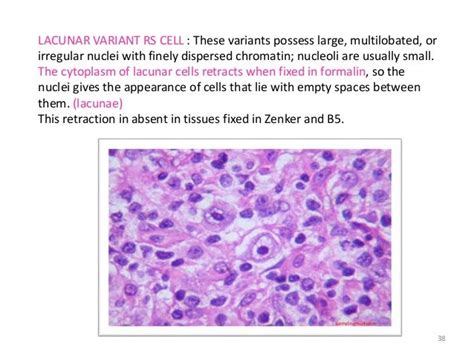 Hodgkin lymphoma