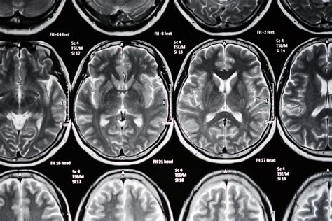 14 Stroke Risk Factors You Can Control (and 5 You Can't) | Reader's Digest