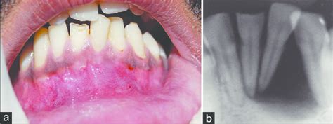 Pre‑operative clinical photograph (a) Pre‑operative intra‑oral... | Download Scientific Diagram