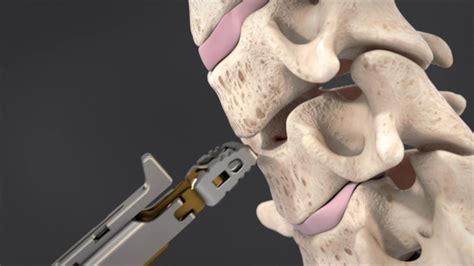 Role of Anterior Cervical Cage Suppliers in The Orthopedics Field