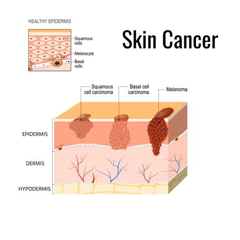 Basal Cell Carcinoma