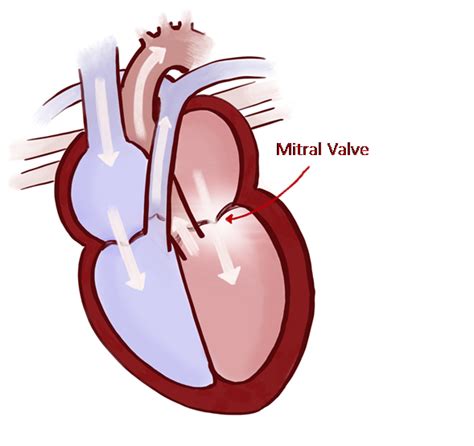 RVC Mitral Valve Disease in Dogs