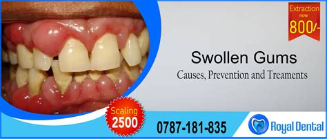Best Of The Best Info About How To Get Rid Of Swollen Gums - Householdother