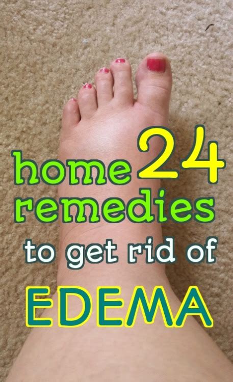 Home Remedy Hacks • 24 Effective Home Remedies To Treat Edema