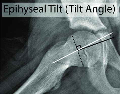 Posterior epiphyseal tilt is determined by first drawing a line... | Download Scientific Diagram