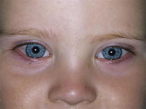 Conjunctivitis in Babies: Types, Symptoms, Causes, Diagnosis, Treatment ...