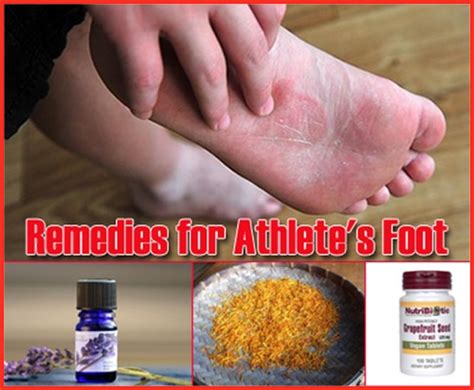 17 Home Remedies For Athletes Foot - Homestead & Survival