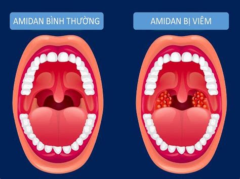 Đau họng, nuốt nước bọt đau có phải mắc Covid-19?