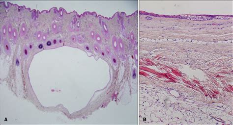 Figure 2 from A Case of Steatocystoma Simplex Involving the Scalp. | Semantic Scholar