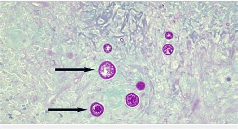 PAS stain showing multiple fungal spherules with endospores (black arrow). | Download Scientific ...