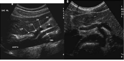 Inferior Mesenteric Artery Ultrasound