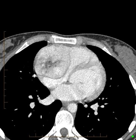 Cardiac paraganglioma (Radiopaedia 76345-88005 A) - NC Commons