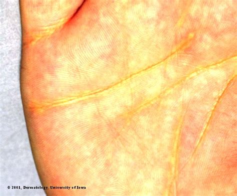 Xanthoma- Palmar Striata | Department of Dermatology