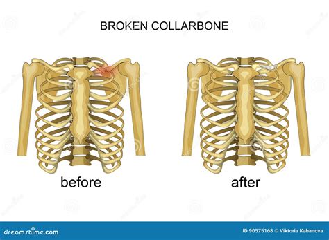 Fracture of the Clavicle. Recovery Stock Vector - Illustration of joint ...