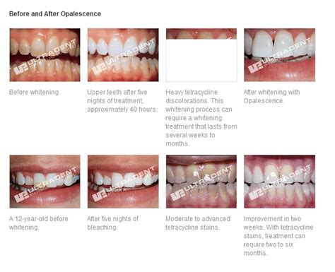 Opalescence Teeth Whitening Instructions