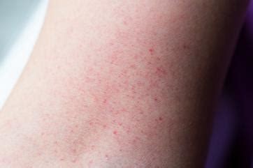 Dengue Fever Rash | LoveToKnow