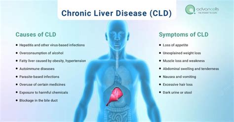 Chronic Liver Disease (CLD) – Causes, Symptoms, Available Treatments - Social Social Social ...