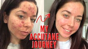 accutane before and after | Public Health