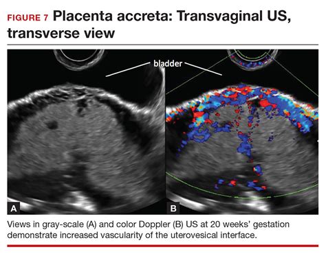 Diagnosing placenta accreta spectrum with prenatal ultrasound | MDedge ObGyn