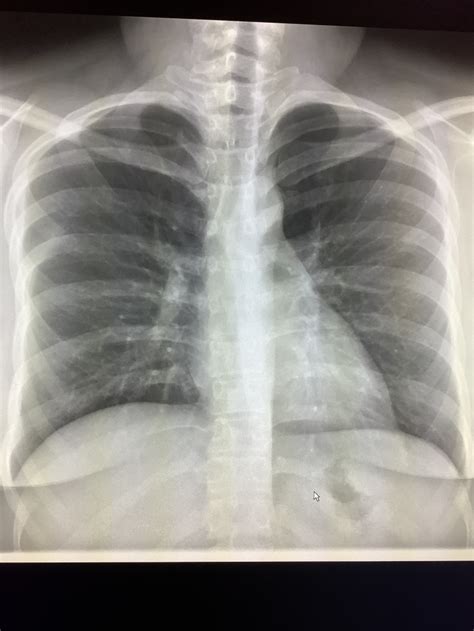 What Does Lung Apex Mean? – Radiology In Plain English