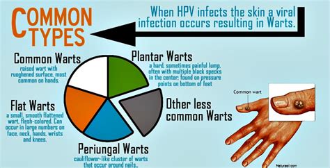 Your Risk for Genital Warts Just Went Up! | Viruses, Diseases, and Treatments