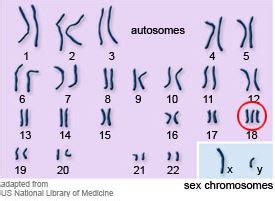 How is Trisomy 18 Diagnosed? – Trisomy 18 Foundation