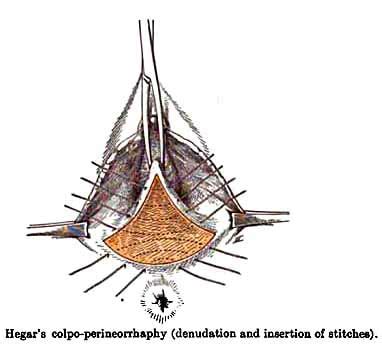 Vaginal surgery - History Of Midwifery, Obstetrics, Gynecology...