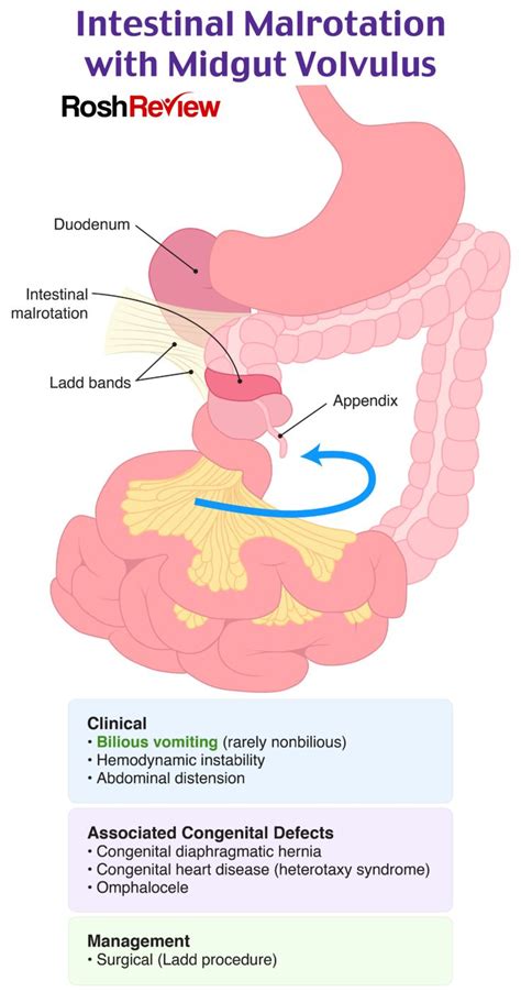 Intestinal Malrotation with Midgut Volvulus | Pediatric medicine, Medical laboratory science ...