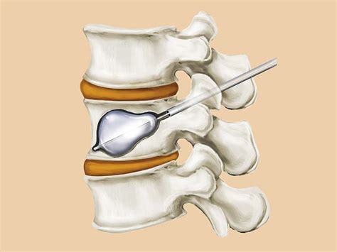 Balloon Kyphoplasty Procedure | London Spine Unit | UK's Best Spinal ...