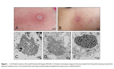 3rd and 4th known cases of ‘Alaskapox’ — both mild — were recently ...