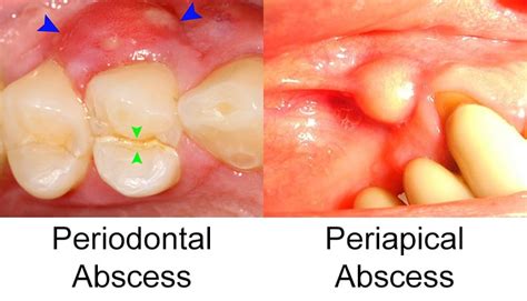 Tooth Abscess Symptoms