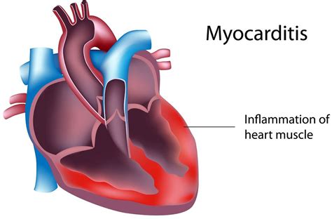 Myocarditis - Causes, Symptoms, Recovery Time, Diagnosis & Treatment