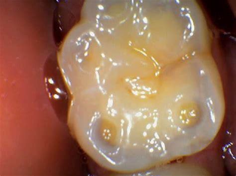 What are wear facets on teeth? | News | Dentagama