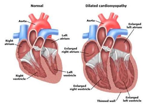 Peripartum cardiomyopathy