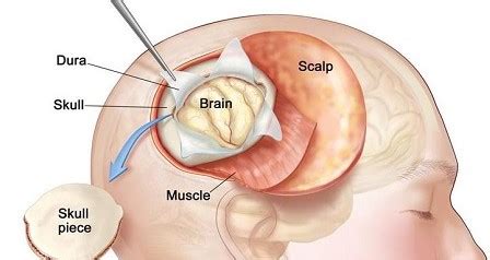 Brain Tumor Surgery Cost in India - Top 10 Neurosurgeon in India